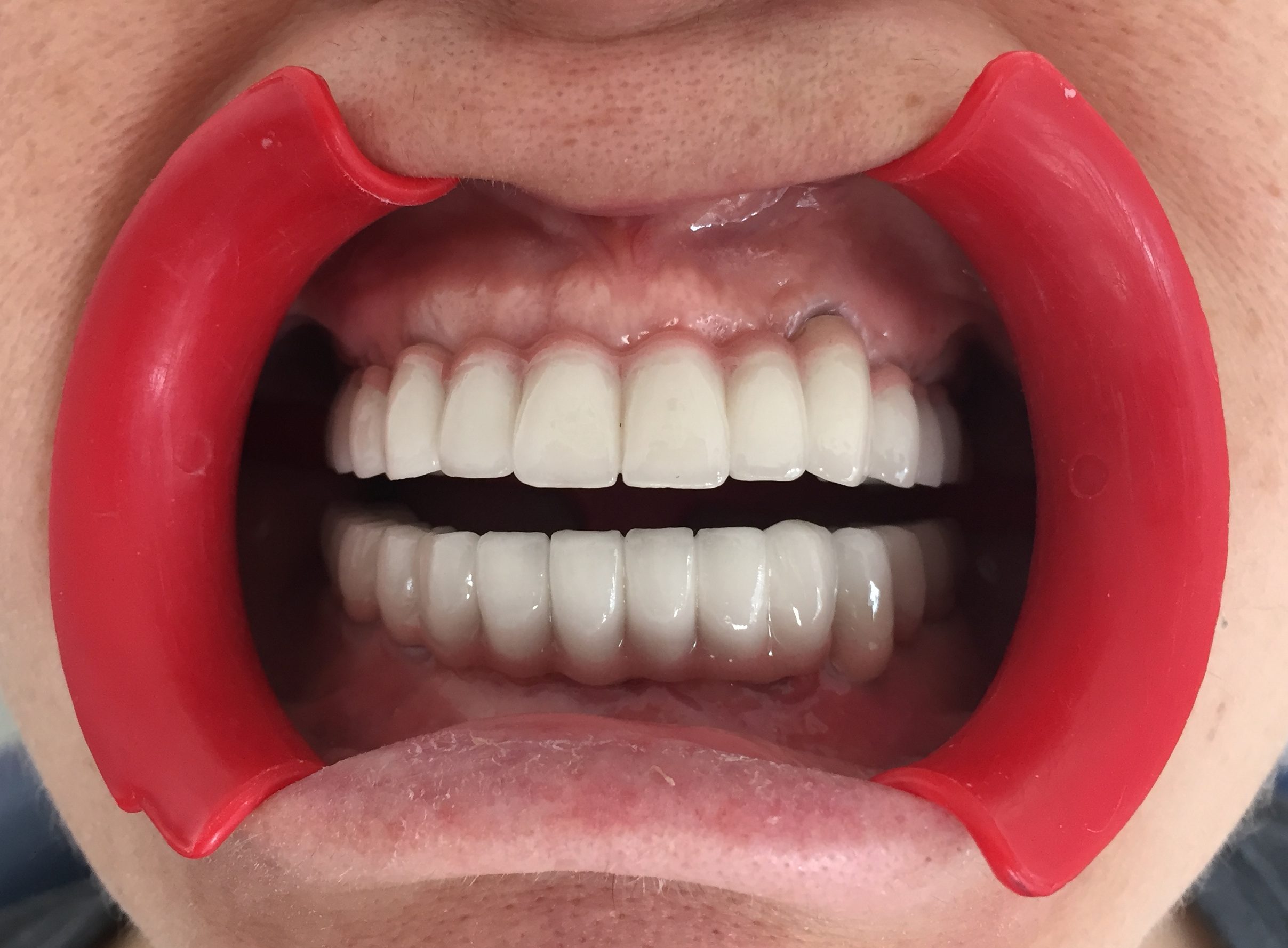 Dental implant Diş Hekimi Konyaaltı Antalya