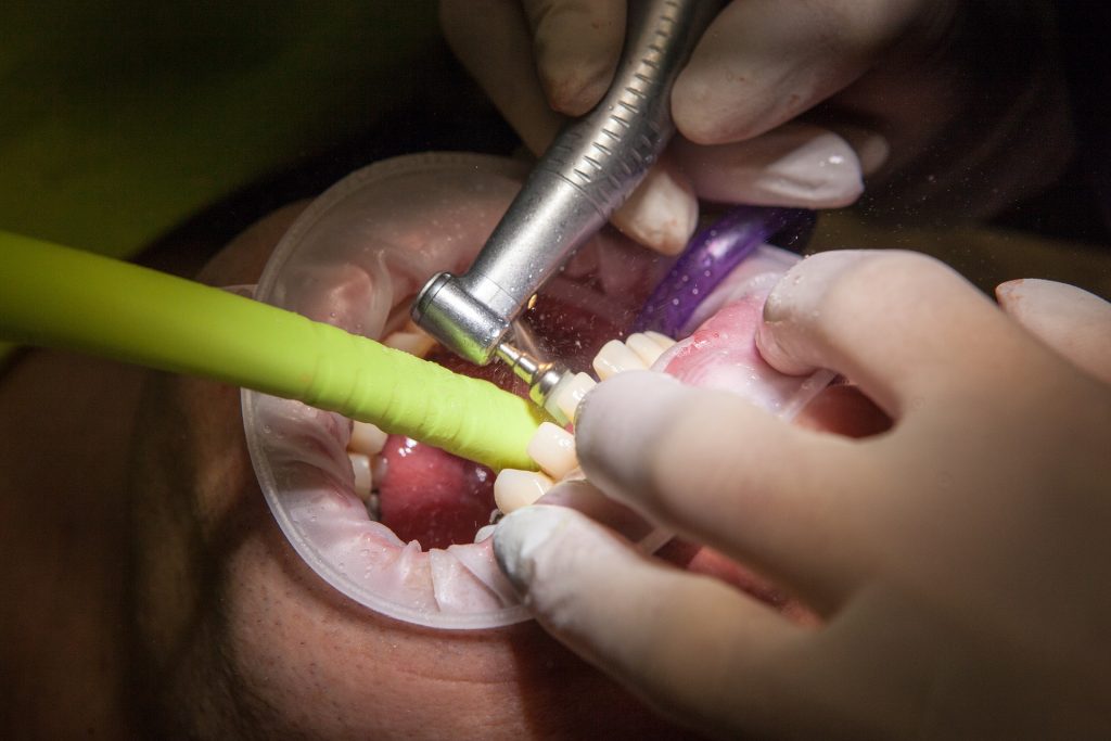diş temizliği yapılırken uygulanan polisaj işlemi