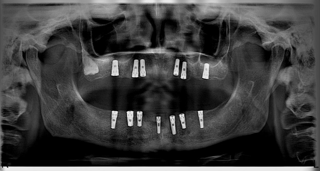 tam diş eksikliğinde implantlar üzerine yapılacak sabit porselen protez
