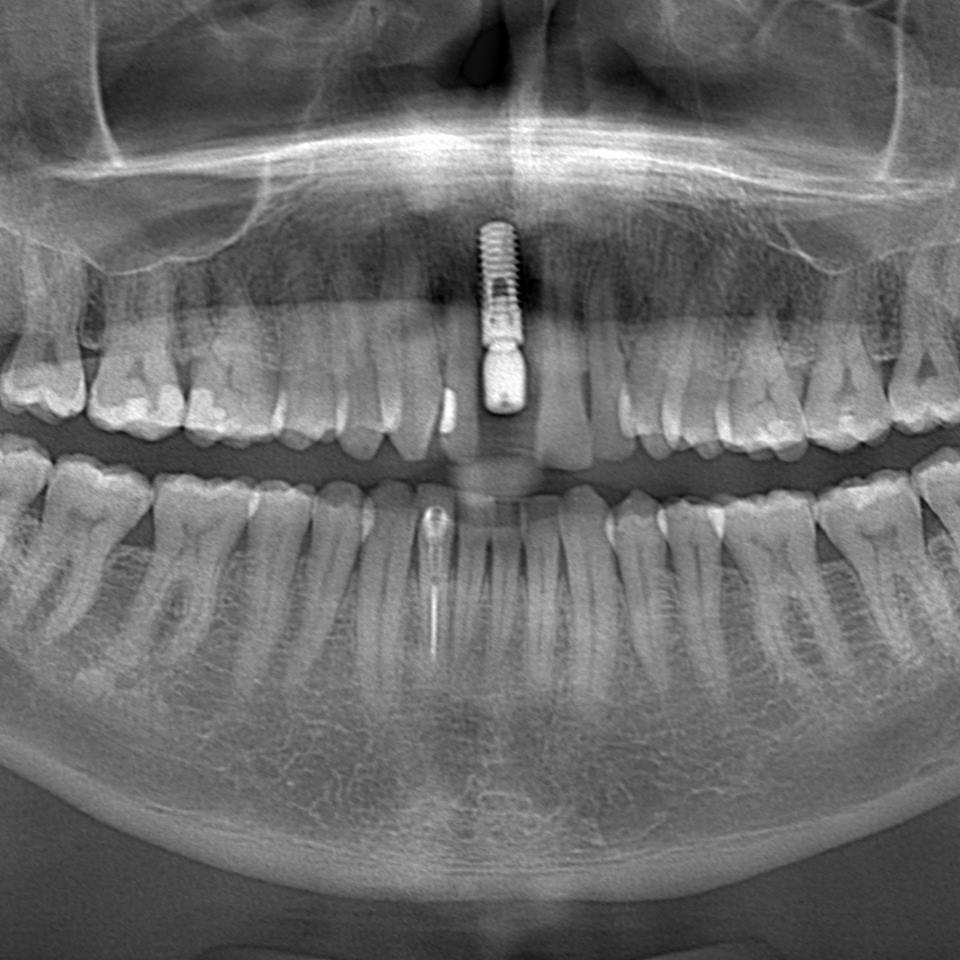 Diş çekim işlemiyle aynı seansta implant uygulaması