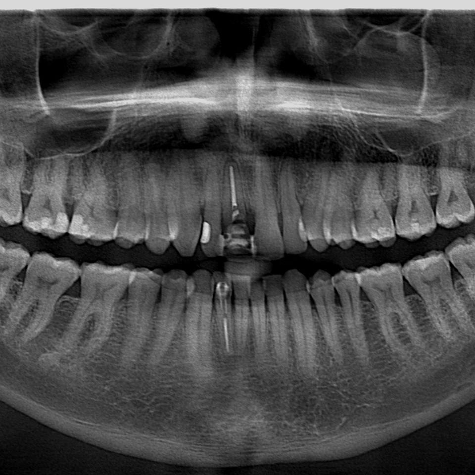 11 no kemik desteğini kaybetmiş sallanan ön diş