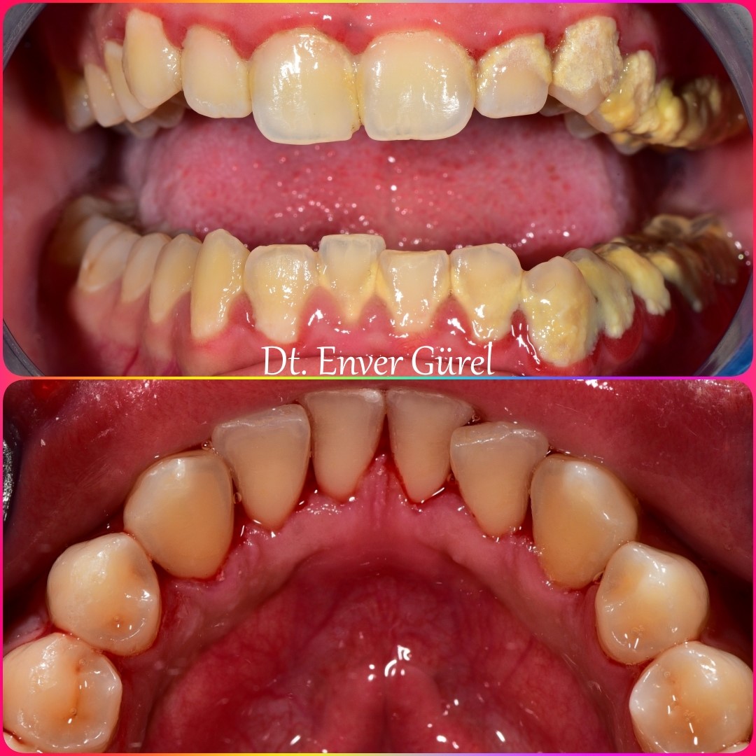 diş taşı tartar temizlik ve gingivitis periodontitis