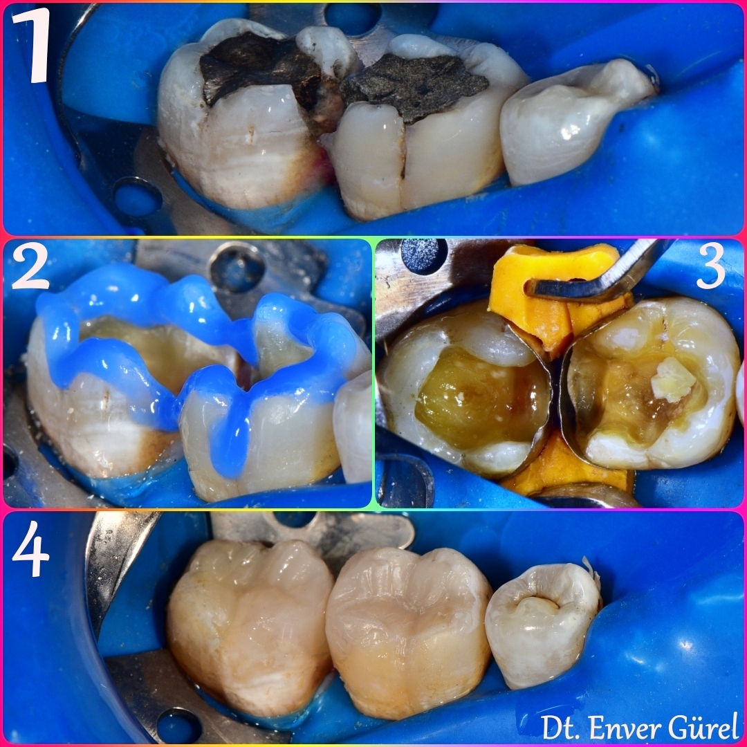 Amalgam dolgu söküm kaldırma Konyaaltı Antalya