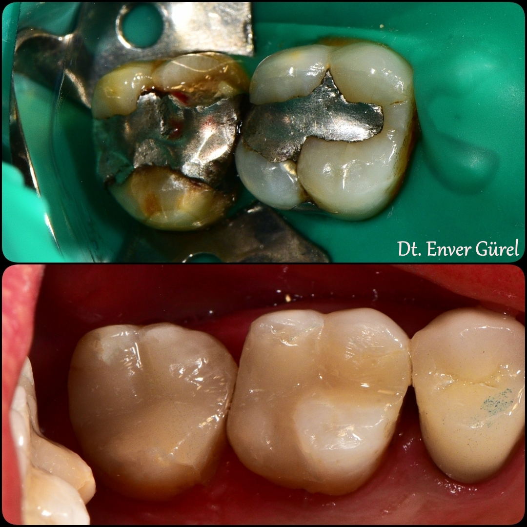 Amalgam dolgu söküm kaldırma Konyaaltı Antalya