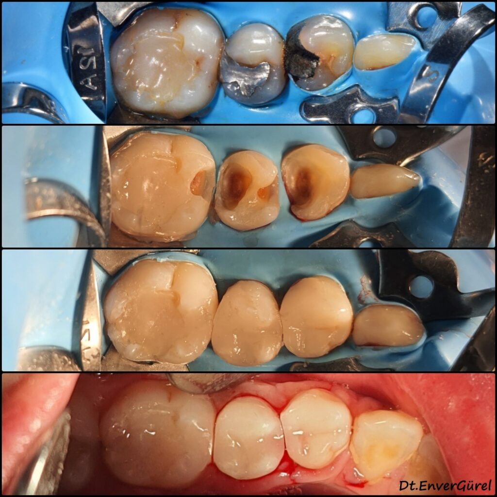 Amalgam dolgu söküm kaldırma Konyaaltı Antalya