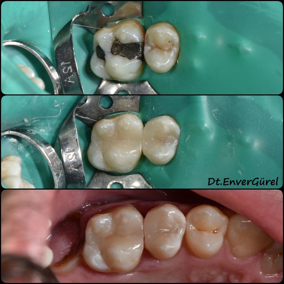 Amalgam dolgu söküm kaldırma Konyaaltı Antalya